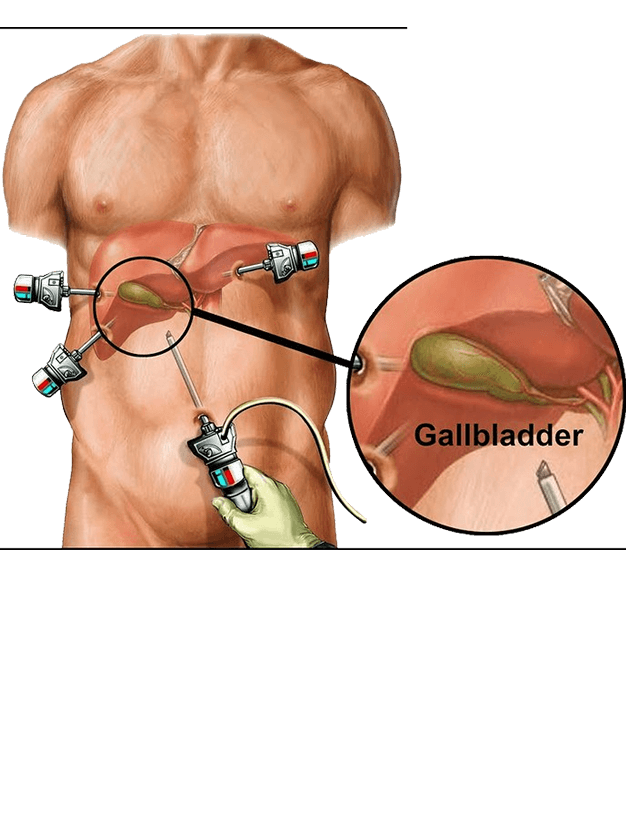 laparoscopic cholecystectomy in mumbai