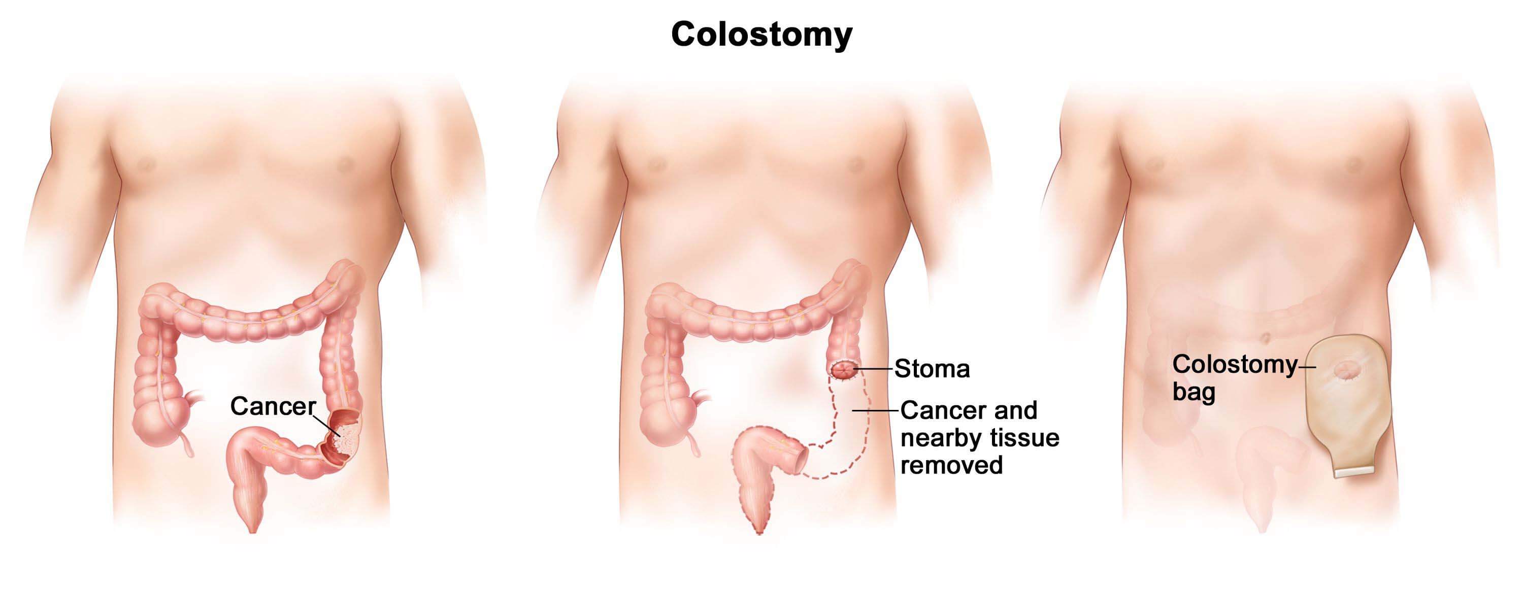 colorectal cancer surgery in mumbai