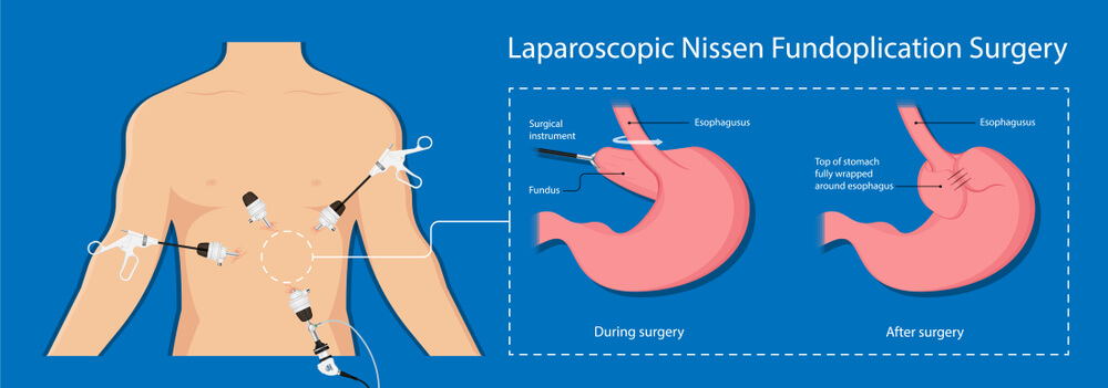 fundoplication surgery in mumbai