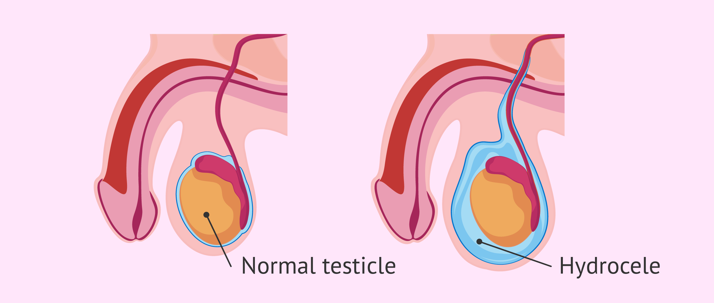 hydrocele treatment in mumbai