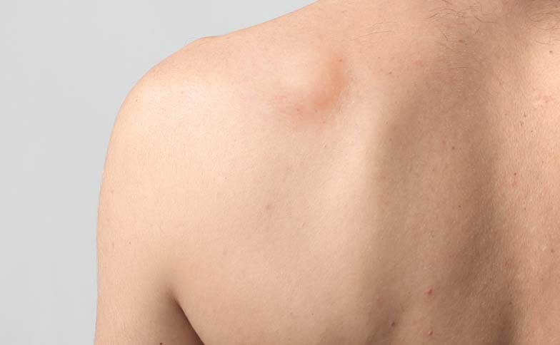lipoma excision (removal) surgery in mumbai