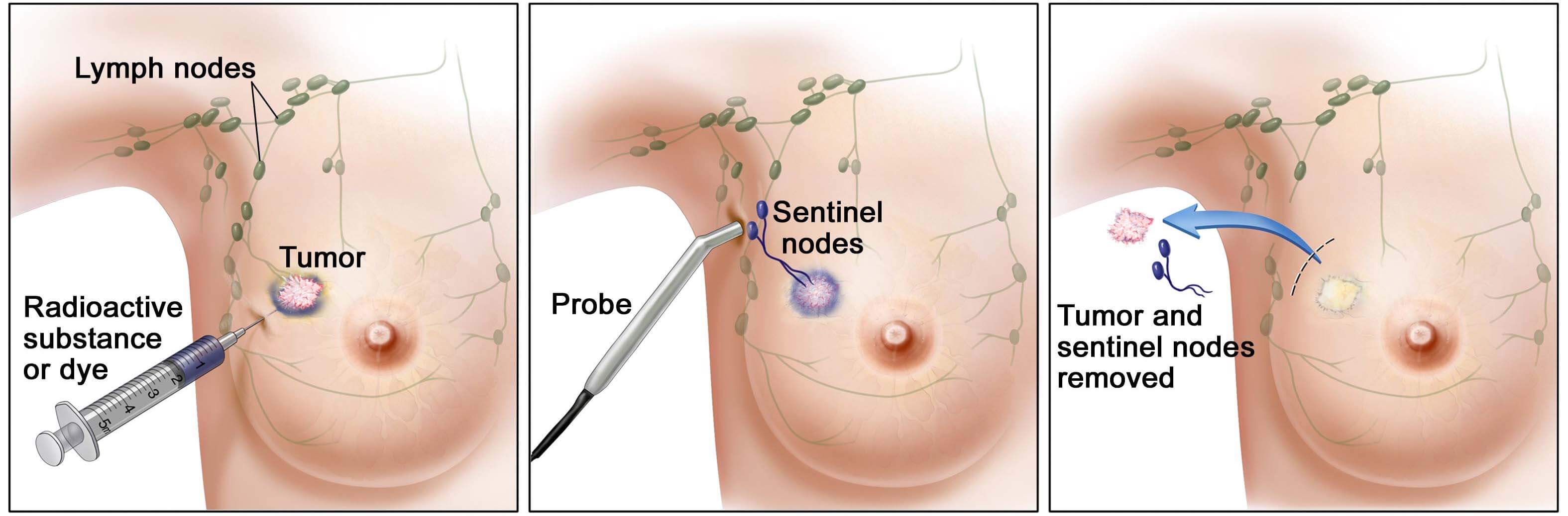 lymph node biopsy in mumbai