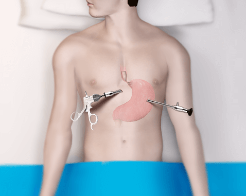 stomach cancer surgery in mumbai